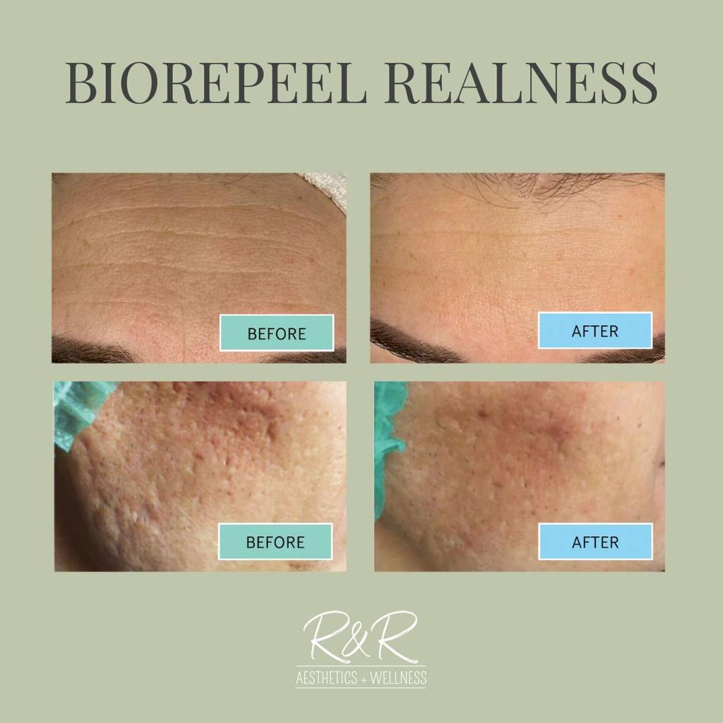 BioRePeel Realness Before and After