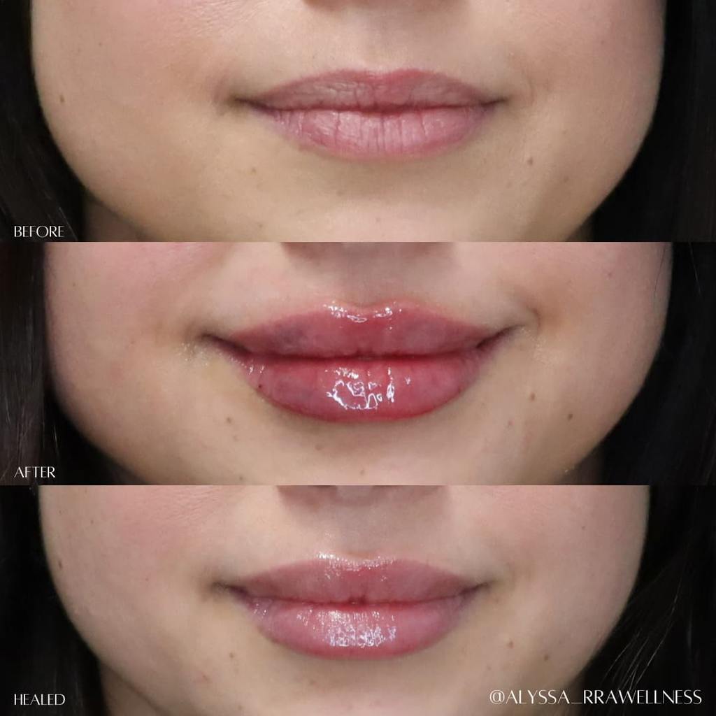 before and after of lips