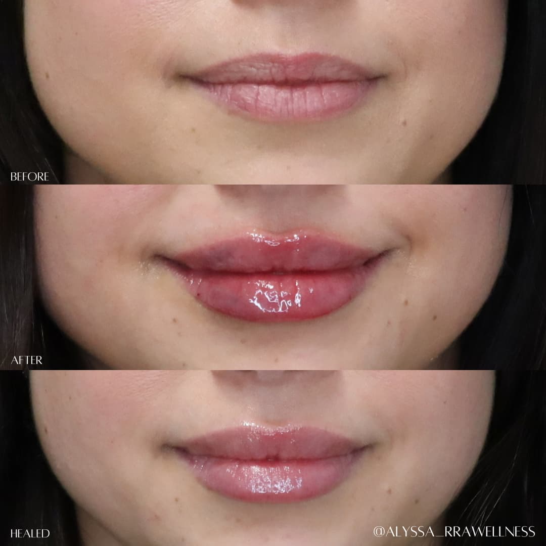 Unveiling the Artistry of Natural-Looking Lip Fillers: A New Era of