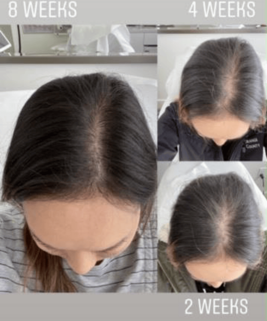 Before and after of hair loss