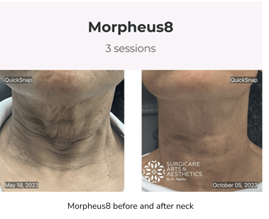 Morpheus8 treatment
